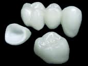 Porcelain Crowns are offered by Foster City dentist Dr. Wong