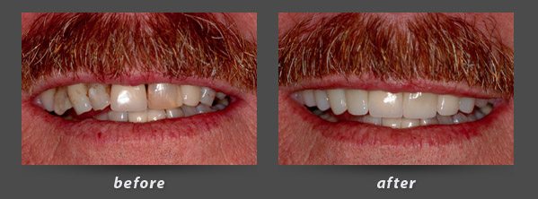 Before and after photos of Burlingame dentist Dr. Wong's patient with dental crowns