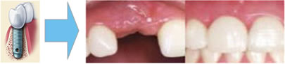 Dental implants can make your smile beautiful again
