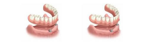 dental implants can secure dentures