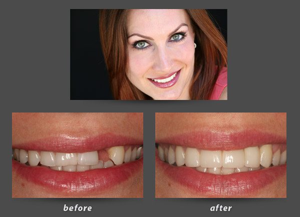 implants-before-after Before and after photos of a patient of Foster City dental implant dentist Dr. Wong who received a dental implant