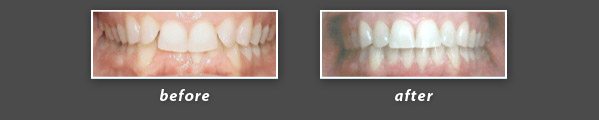 before and after photos of Invisalign patient of Dr. Wong, a Burlingame dentist