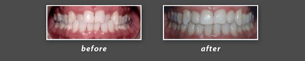 before and after photos of patient treated with Invisalign by Foster City dentist Dr. Wong