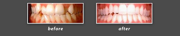 before and after photos of Invisalign patient of San Mateo dentist Dr. Wong