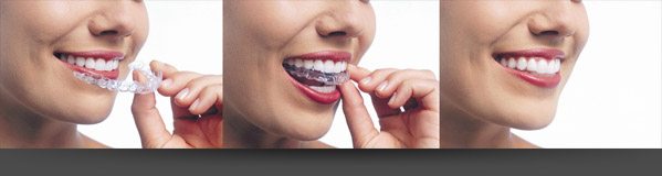 invisaligntrays Burlingame dentist Dr. Wong offers Invisalign