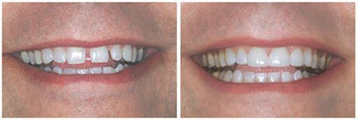 before and after photos of a dental veneers patient of Foster City dentist Dr. Wong