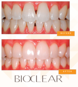 before-after-bioclear
