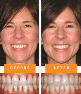 before-after-bioclear-smile