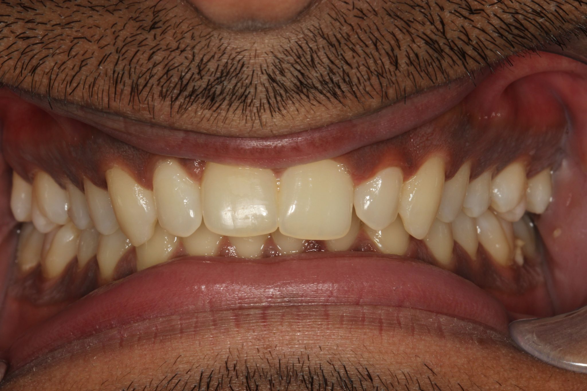 » Categories » Invisalign Treatment