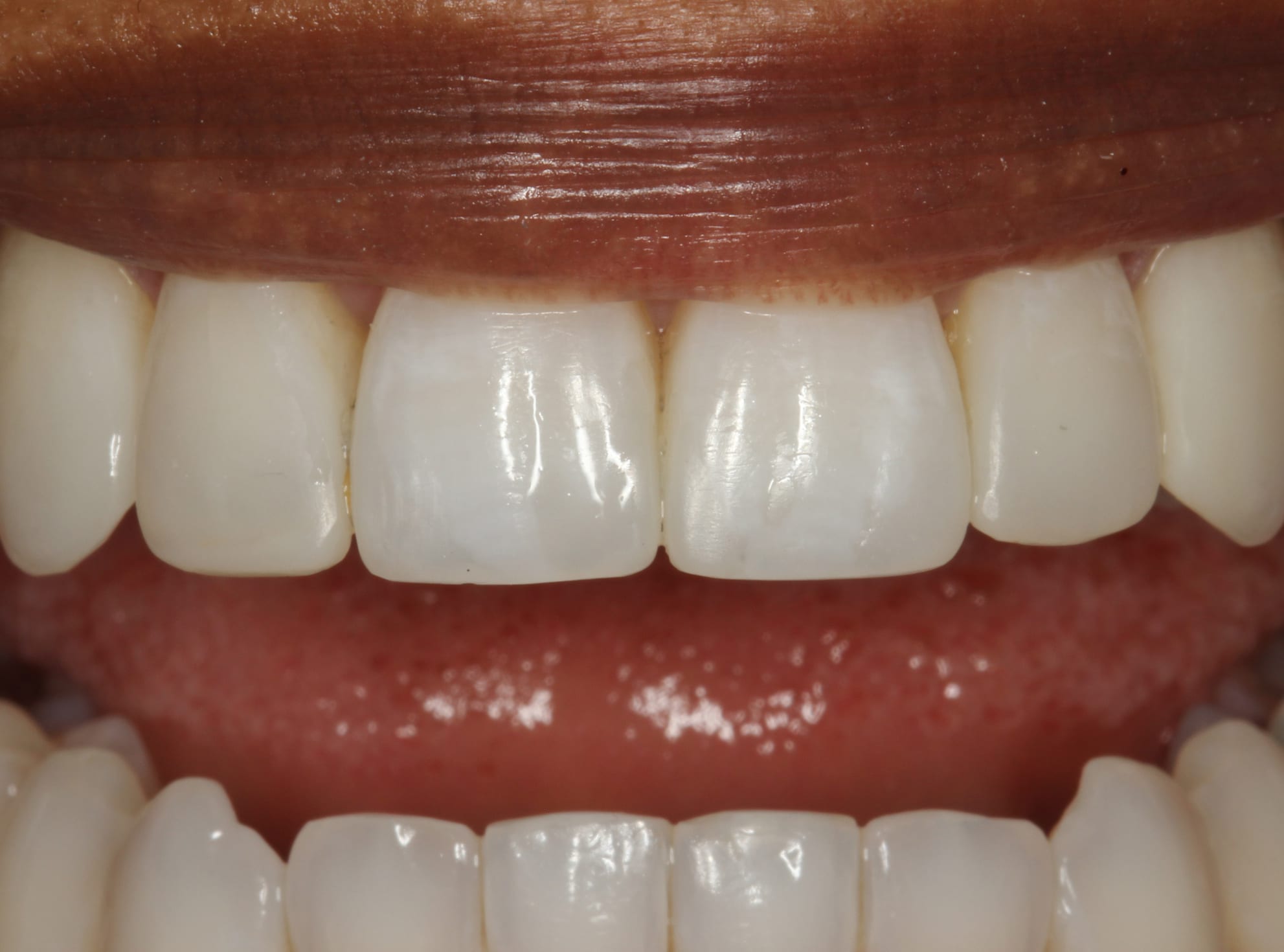 Smile Gallery Before and After Cosmetic Dentists in San Mateo