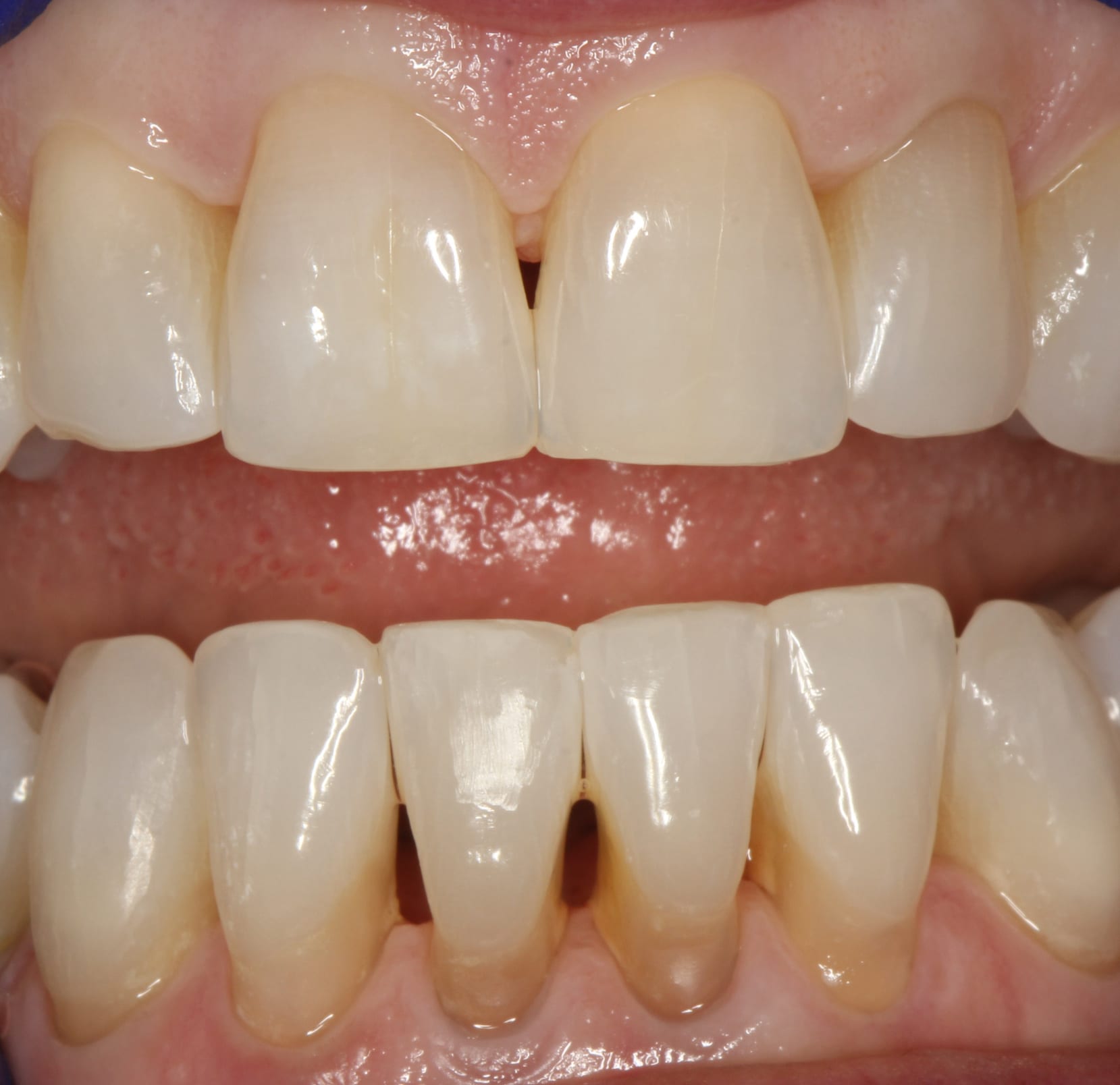 Bioclear Restorations San Mateo Center for Cosmetic Dentistry